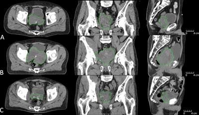 Case Report: MR-Guided Adaptive Radiotherapy, Some Room to Maneuver